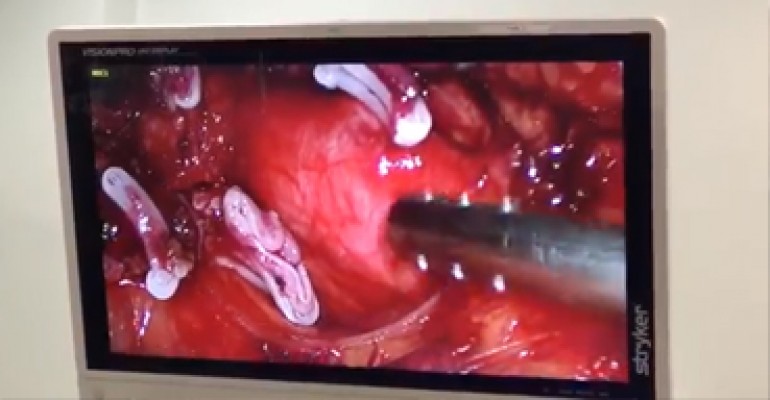 Nefrectomia vídeo-laparoscópica