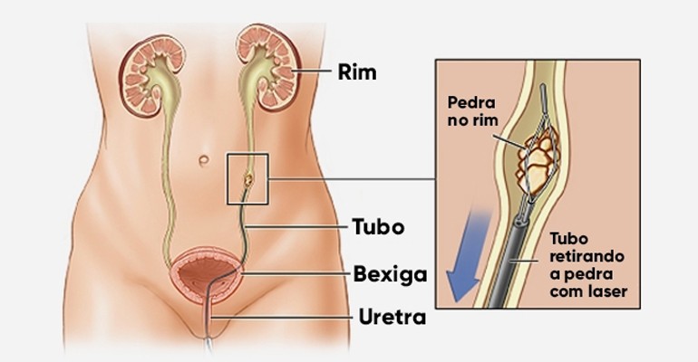 Ureteroscopia flexível com laser para tratamento de cálculos urinários.